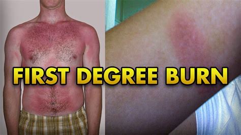 how did grime get burned.